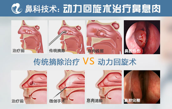鼻息肉传统手术与动力回旋手术对比