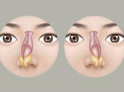 鼻中隔偏曲的症状表现